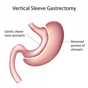 Bariatric Surgery - K & B Surgical Center